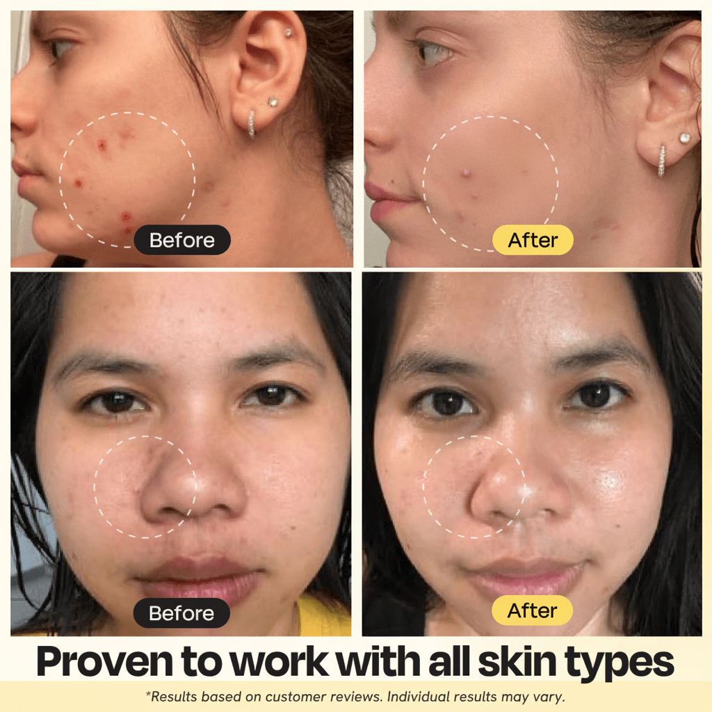 Before After All Skin Types